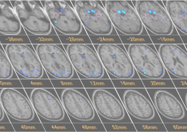 プレミアム脳ドック3テスラ（早期認知症チェックつき） 脳MRI・頭部MRA・頸部MRA・早期認知症(VSRAD)