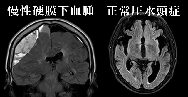 認知症脳ドック3テスラ（早期認知症チェックつき）